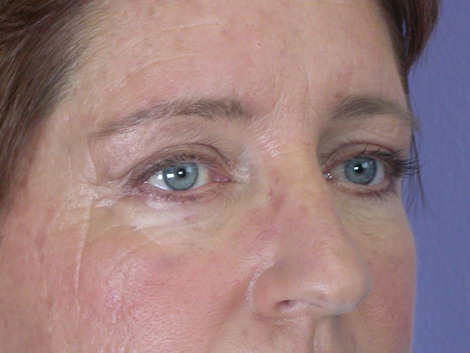 Eyelid Surgery before and after photo