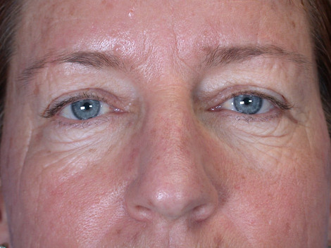 Eyelid Surgery before and after photo