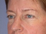 Eyelid Surgery Before and after photo