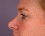 Eyelid Surgery Before and after photo