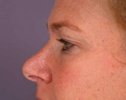 Eyelid Surgery before and after photo