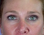 Eyelid Surgery Before and after photo