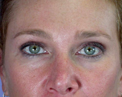 Eyelid Surgery before and after photo