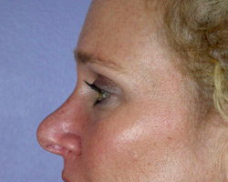 Eyelid Surgery before and after photo