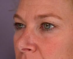 Eyelid Surgery before and after photo