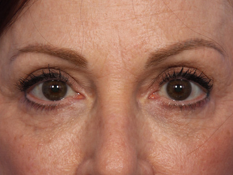 Injectable Fillers before and after photo