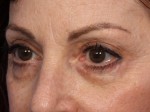 Injectable Fillers Before and after photo