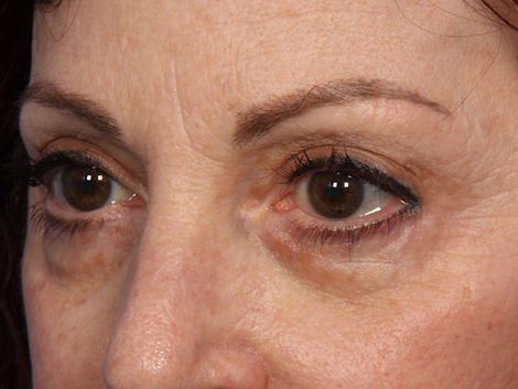 Injectable Fillers before and after photo