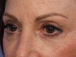 Injectable Fillers Before and after photo