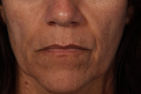 Injectable Fillers before and after photo