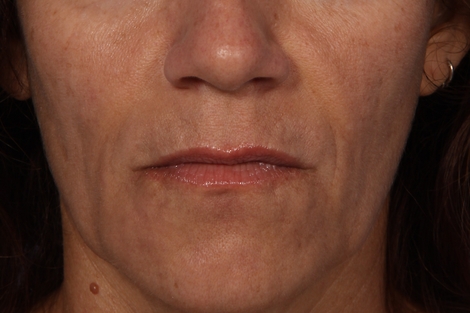 Injectable Fillers before and after photo