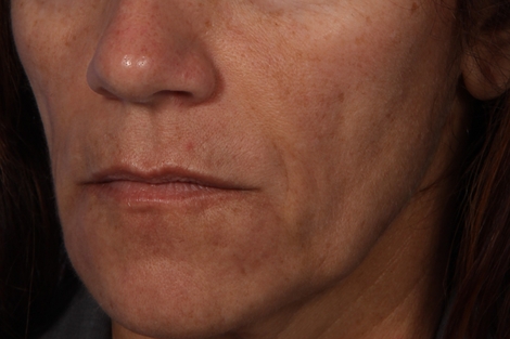 Injectable Fillers before and after photo