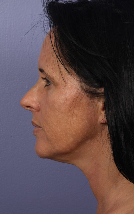 Facelift before and after photo