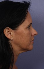 Facelift Before and after photo