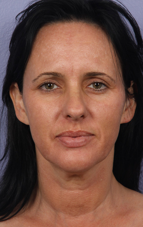 Facelift before and after photo