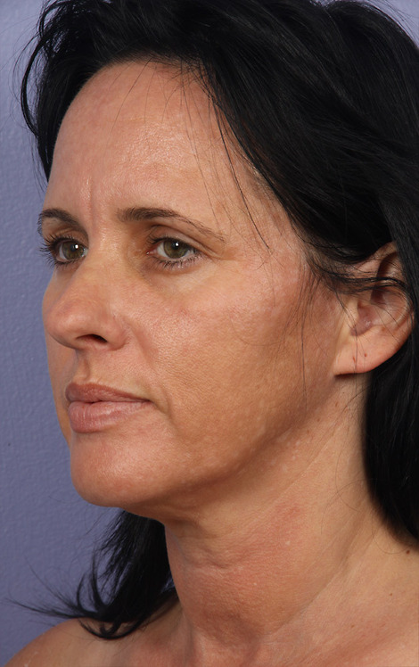 Facelift before and after photo