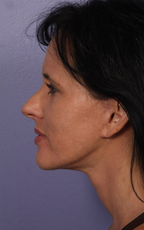 Facelift before and after photo