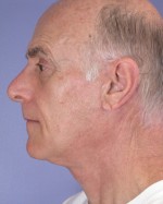 Facelift Before and after photo