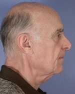 Facelift Before and after photo