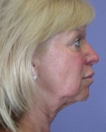 Facelift Before and after photo