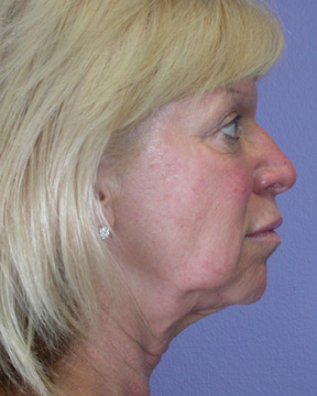 Facelift before and after photo