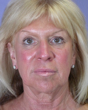 Facelift before and after photo