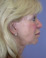 Facelift Before and after photo