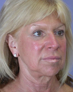 Facelift before and after photo