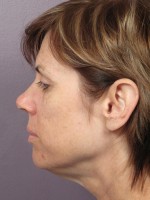 Facelift Before and after photo