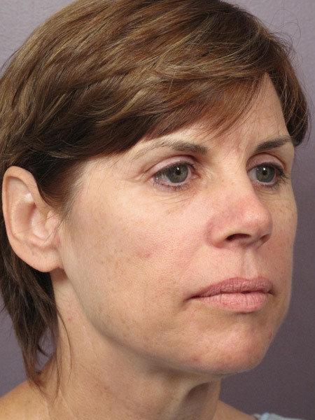 Facelift before and after photo