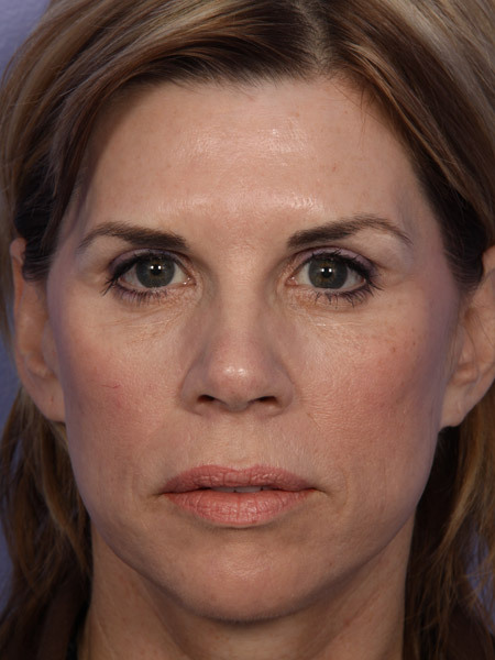 Facelift before and after photo