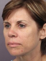 Facelift Before and after photo