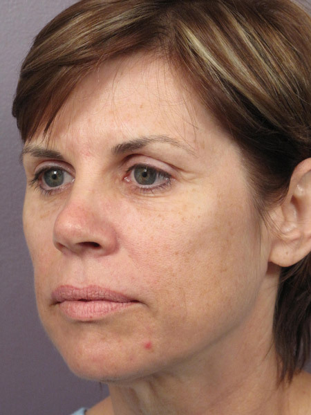 Facelift before and after photo