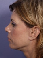 Facelift Before and after photo