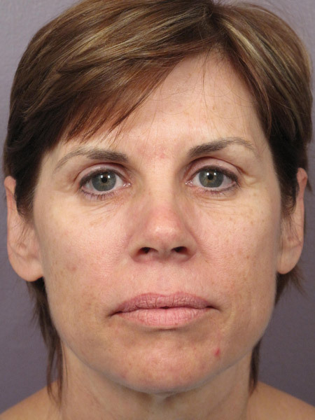 Facelift before and after photo