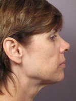 Facelift Before and after photo