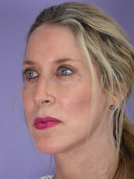 Facelift before and after photo