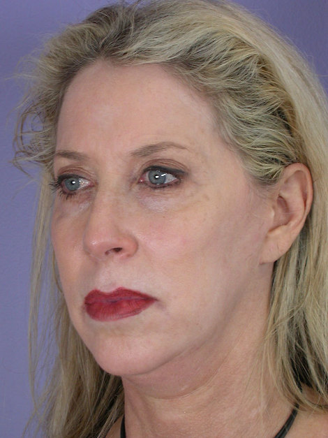 Facelift before and after photo