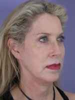 Facelift Before and after photo