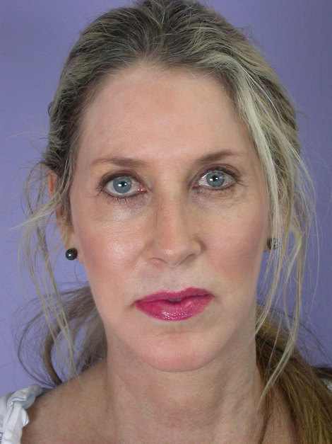 Facelift before and after photo