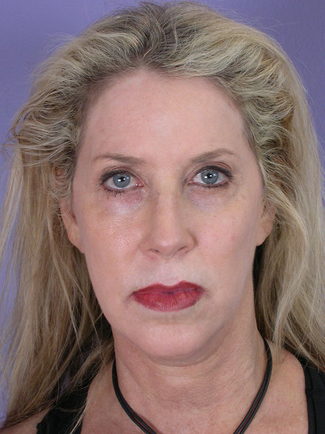 Facelift before and after photo