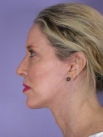 Facelift Before and after photo