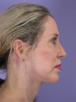 Facelift Before and after photo