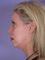 Facelift Before and after photo