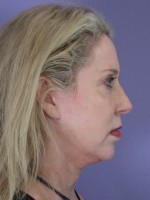 Facelift Before and after photo