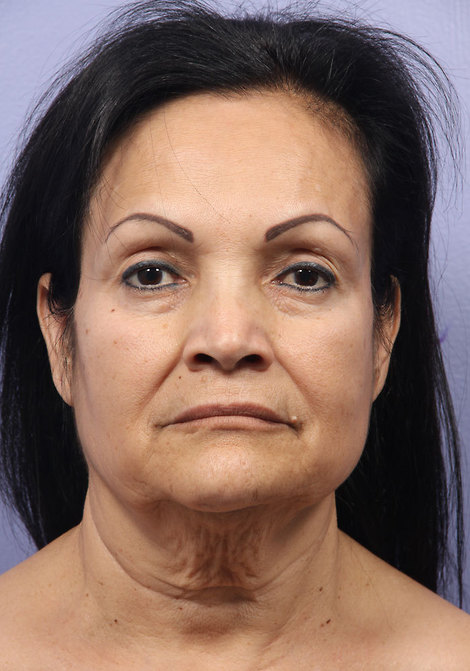 Facelift before and after photo