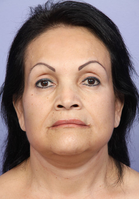 Facelift before and after photo