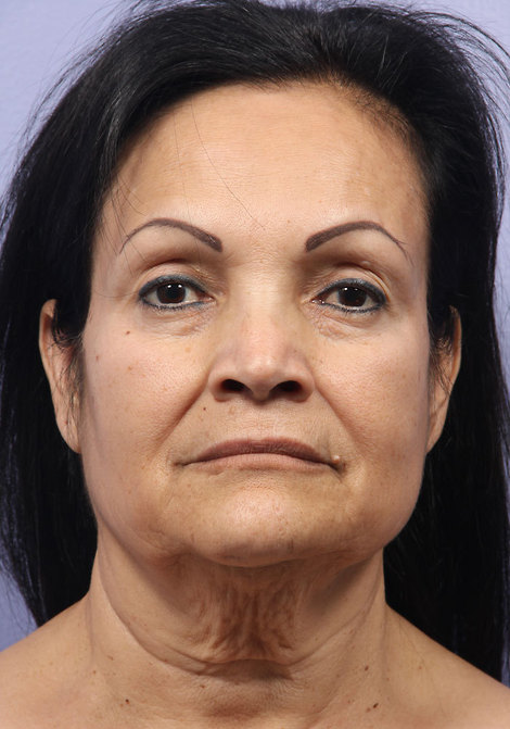 Facelift before and after photo