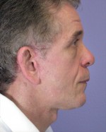 Facelift Before and after photo