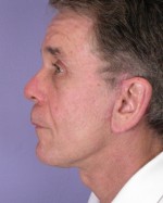 Facelift Before and after photo